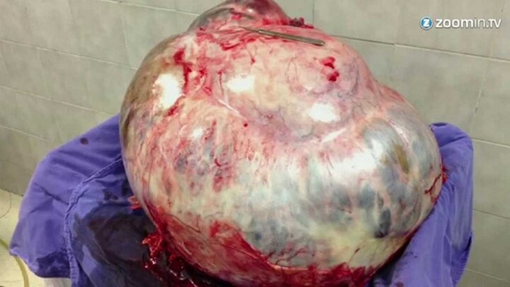 Người phụ nữ có khối u 60kg lớn bậc nhất thế giới