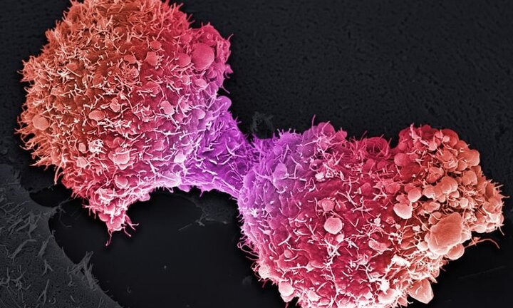 Nếu thấy những dấu hiệu này, 90% bạn bị ung thư tuyến tụy