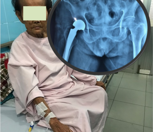 Mắc 5 bệnh, lại bị tai nạn gãy cổ xương đùi, cụ bà nguy kịch