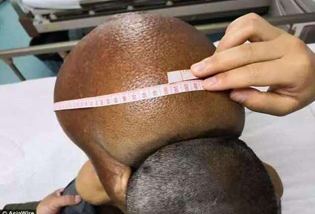 Đeo khối u nặng 15kg suốt 47 năm sau gáy, người đàn ông khốn khổ 'sống không bằng chết'