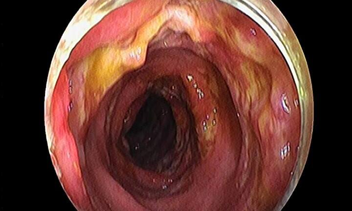Tự tiện chữa bệnh tại nhà, người đàn ông bị biến chứng nhiễm trùng máu suýt chết
