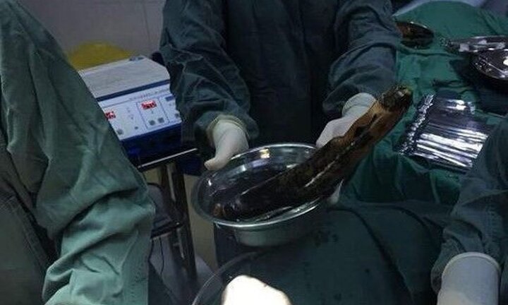 Nhét cà tím vào hậu môn để tự chữa táo bón, người đàn ông nhập viện