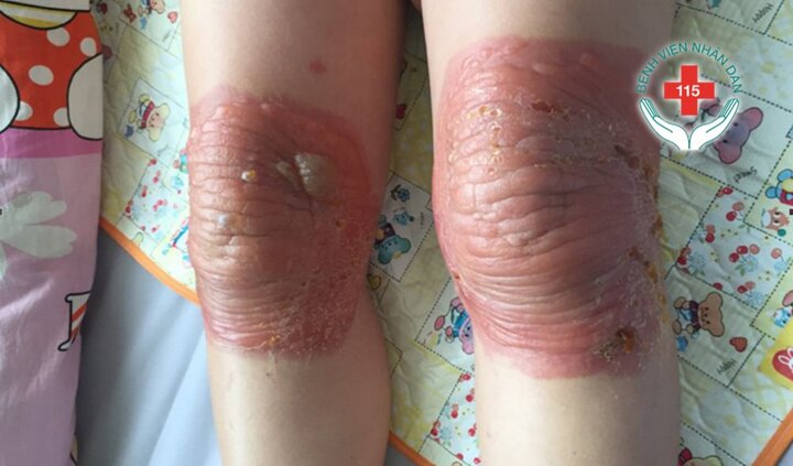 Mặt sưng tấy, chân teo đi, người đàn ông biến dạng vì chữa khớp bằng thuốc đông y trôi nổi