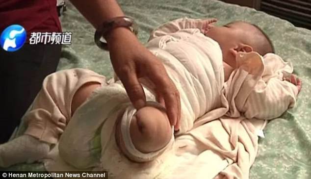 Bị bỏng máy sấy tóc do y tá bất cẩn, em bé phải cưa một chân khi mới chỉ 4 ngày tuổi