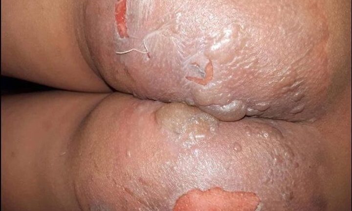 Đang ngồi xem bóng đá, hai em bé bị bà hàng xóm hắt nước sôi luộc bầu bỏng nặng