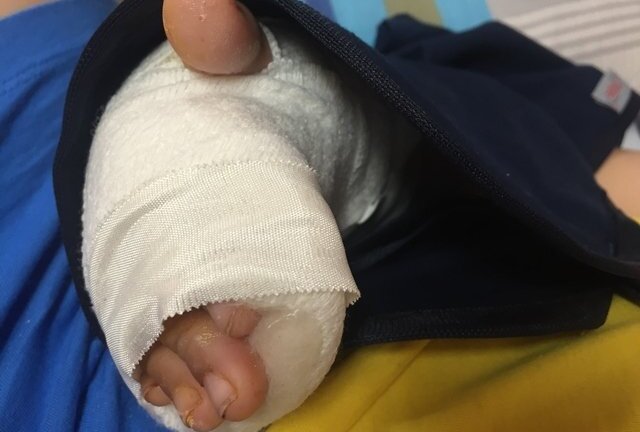 Bị mảnh thủy tinh cứa đứt động mạch cổ tay, bé trai nguy kịch