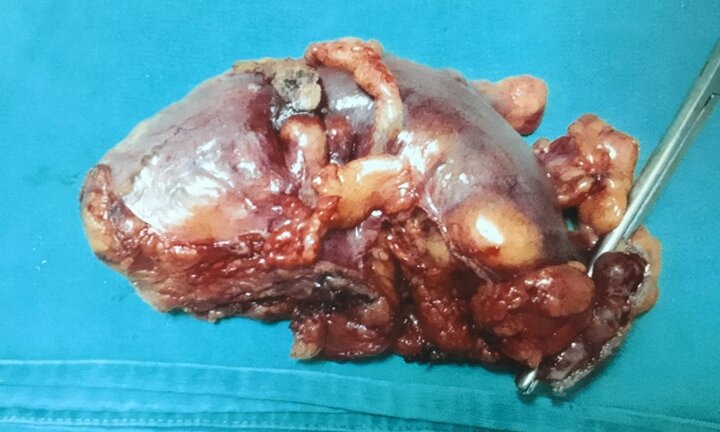 Vật lộn loại bỏ khối u đại tràng cho cụ ông 76 tuổi