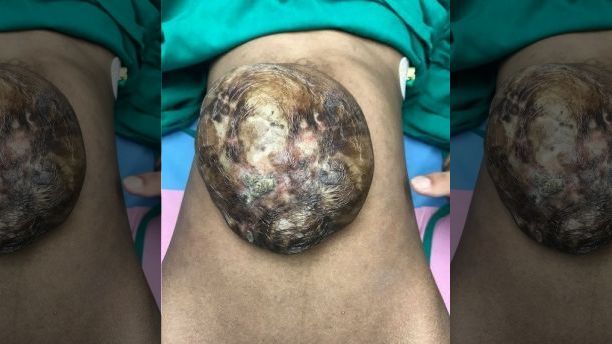 Xót xa cô gái có gan, ruột nằm bên ngoài cơ thể 19 năm