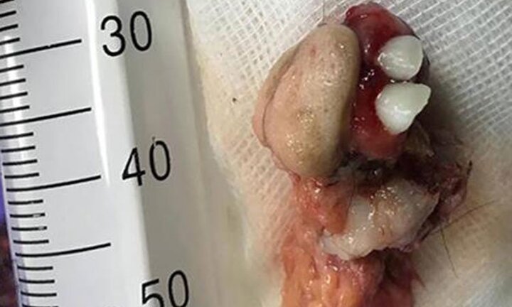 Khối u quái có răng, tóc, xương trong buồng trứng bé gái