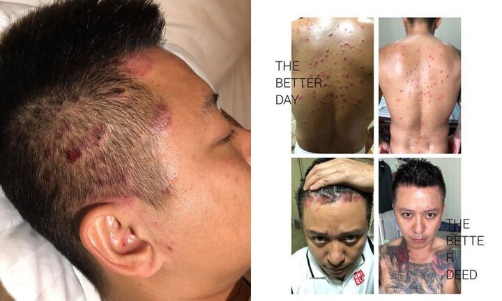 Bệnh vẩy nến mà ca sĩ Tuấn Hưng mắc phải nguy hiểm thế nào?