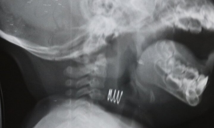 Chiếc lò xo han gỉ mắc trong thực quản bé gái 7 tháng tuổi