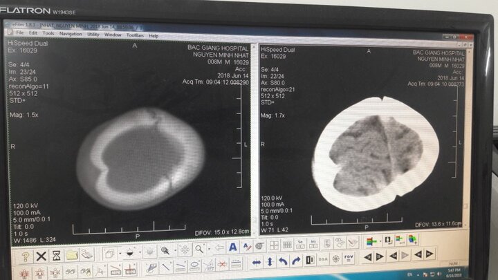 Đập đầu xuống nền đất cứng, bé trai 8 tháng tuổi lún sọ não