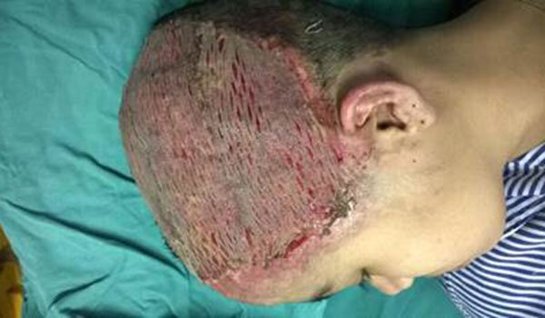 Uốn tóc đón sinh nhật, cô gái 17 tuổi bỏng nặng, lở loét da đầu