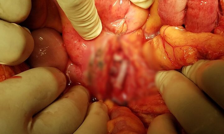 Bị tảng đá rơi vào lưng, chàng trai dập vỡ nhiều cơ quan nội tạng