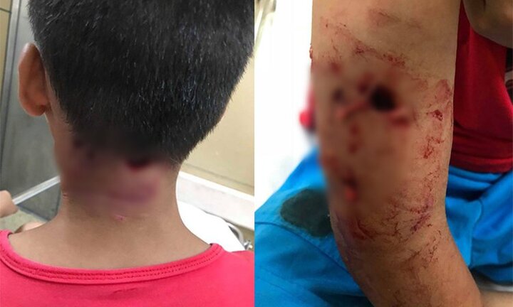 Thêm một bé trai bị chó cắn thủng tay và gáy khi cho chó ăn