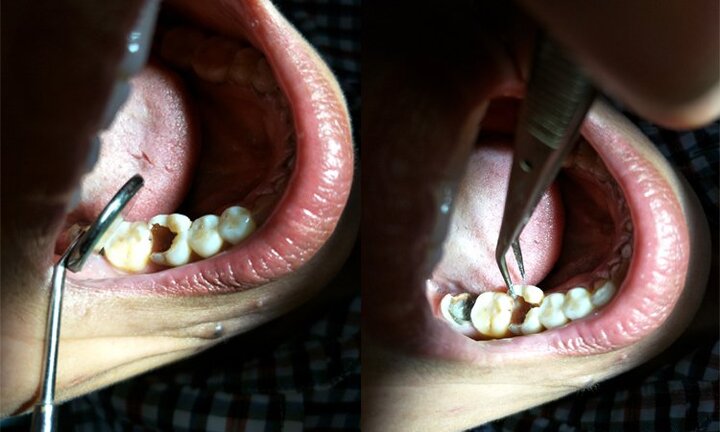 Rùng mình chiếc răng rỗng tuếch, vỡ đôi trong miệng bệnh nhân