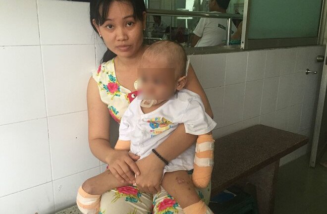 Hoại tử, thối thịt, tội nghiệp bé 2 tuổi phải cắt tứ chi