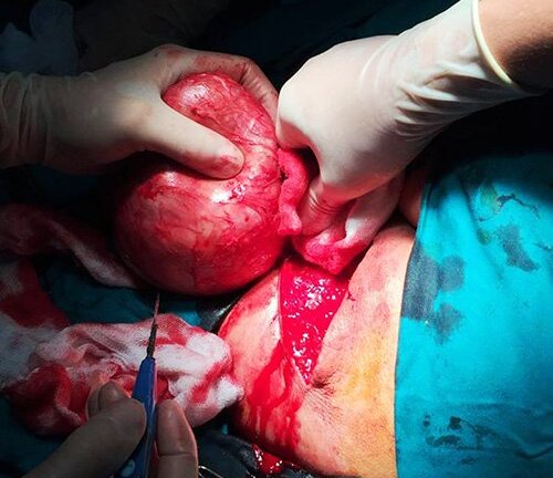 Cắt bỏ khối u ở mông nặng hơn 1 kg cho cụ bà gần 90 tuổi