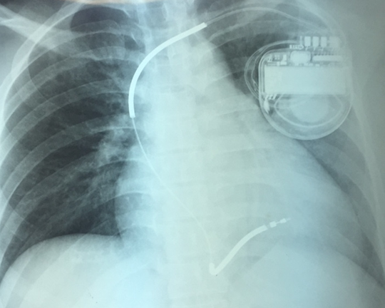 Đặt máy vào ngực, đưa người phụ nữ trẻ về từ cõi chết