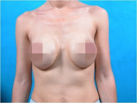 'Hãi hùng' những bộ ngực dị dạng, xập xệ không tưởng sau nâng cấp