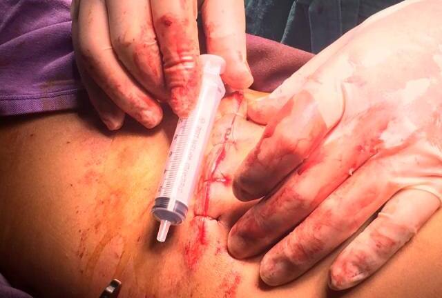 Cứu sống thanh niên bị đâm thấu thành bụng nguy kịch, chảy máu dữ dội