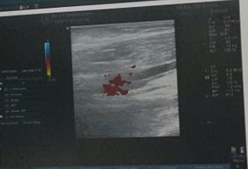 Thương tâm bé 5 tuổi mất cánh tay do bị cuốn vào băng chuyền