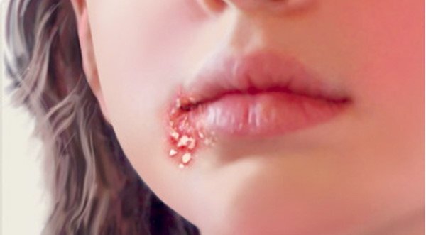 4 căn bệnh lây nhiễm qua đường tình dục ít người ngờ tới