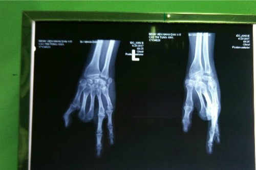 Lấy 2 ngón chân ghép thành ngón tay cho cô gái trẻ