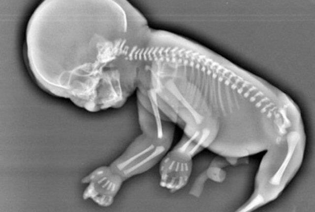 Bà bầu 6 tháng ngỡ ngàng vì mang thai 'nàng tiên cá'