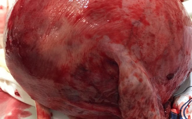 Phẫu thuật lấy thai cho sản phụ có khối u xơ tử cung nặng 2,8kg