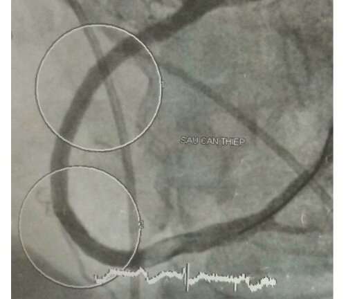 Bác sĩ nhiều viện hợp sức cứu đồng nghiệp bị nhồi máu cơ tim