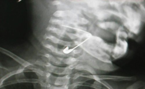 Bé 18 tháng tuổi nuốt kim băng mắc vào thanh quản