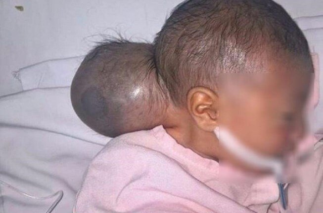 Thương tâm bé gái bị bỏ rơi có khối u to như đầu