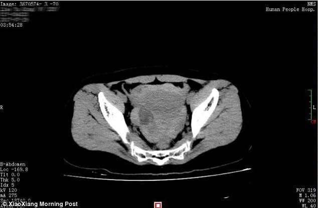 Suýt chết vì 'sex' quá đà làm vỡ nang buồng trứng