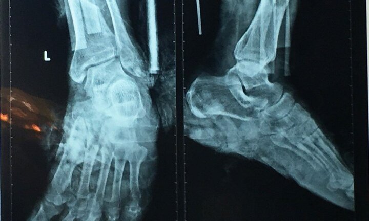 Sơ ý, cụ ông bị máy cắt cỏ cắt gần lìa cẳng chân