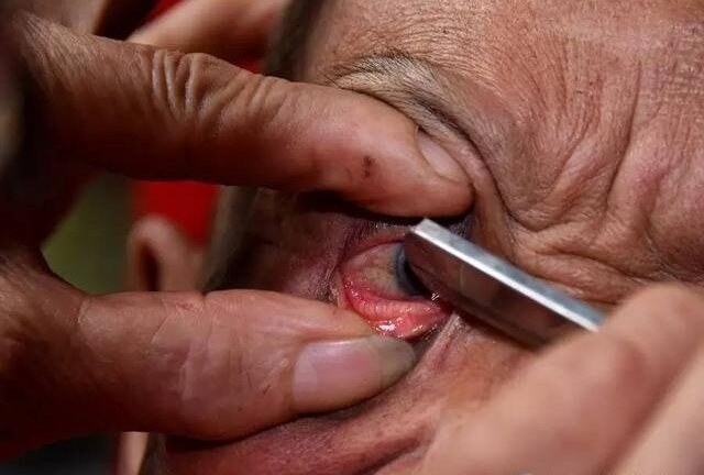 Rợn người cảnh dùng dao lam sắc lẻm làm sạch mí mắt kiểu cổ xưa