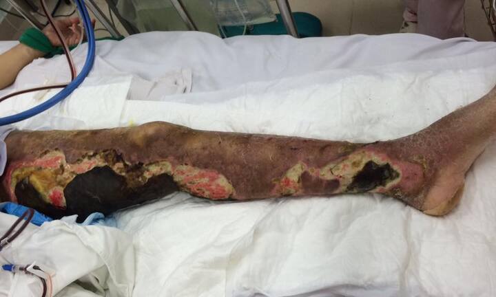 Chân hoại tử bốc mùi hôi thối vì tin 'bác sĩ google' hơn bác sĩ thật