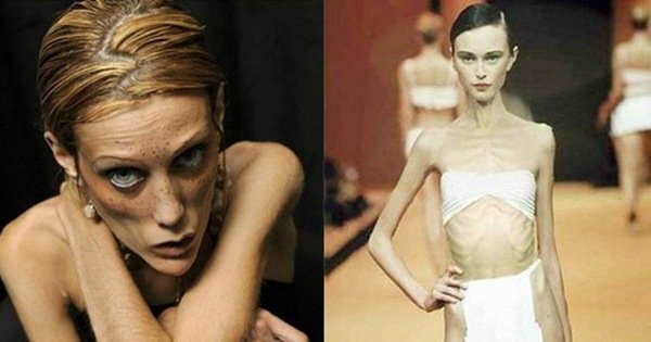 Sự thực bất ngờ: Phụ nữ siêu gầy dễ vô sinh, bệnh tật không kém người béo phì