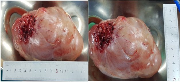 Phẫu thuật thành công bệnh nhân nữ 74 tuổi bị u lớn chèn ép tim phổi