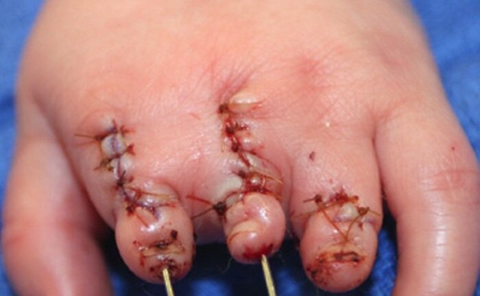 Nhói lòng trước hàng loạt em bé mắc bệnh như Bôm, con trai diễn viên Quốc Tuấn