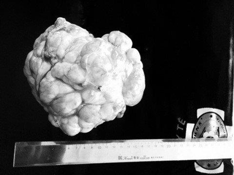 Cứu bé 3 tuổi có khối u nặng 3kg, choán gần hết ổ bụng