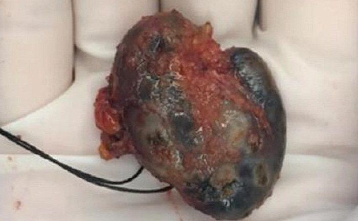 Nhiễm mực từ hình xăm, nữ bệnh nhân mắc khối u kỳ lạ