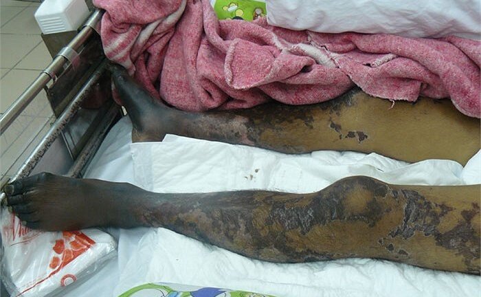 Nhiễm trùng máu, suy đa tạng nguy kịch vì mê tiết canh tươi sống