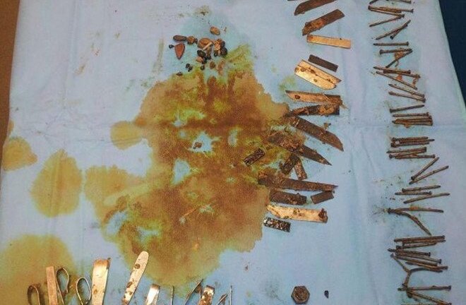 Người đàn ông tâm thần nuốt đinh vít, cán thìa, lưỡi dao