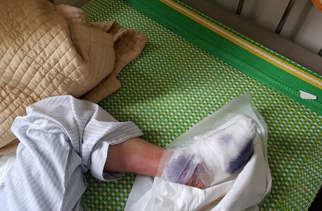 Nỗi ám ảnh của bệnh nhân tiểu đường khi phải cắt chân