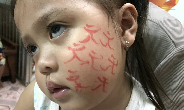 Bé gái nhập viện cấp cứu vì để thầy cúng vẽ bùa lên mặt chữa bệnh