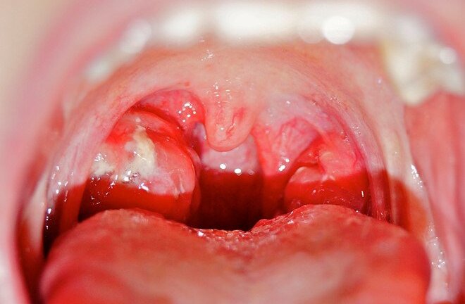 Những biến chứng nguy hiểm khi trẻ bị viêm mũi họng