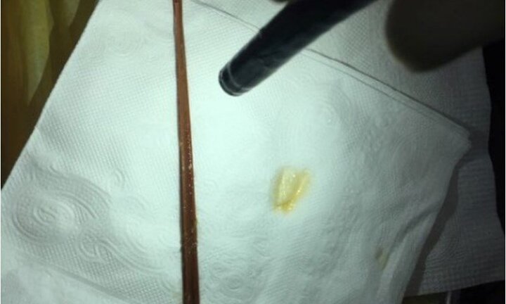 Nhập viện vì ăn 6 cây nhang đang cháy làm mồi nhậu