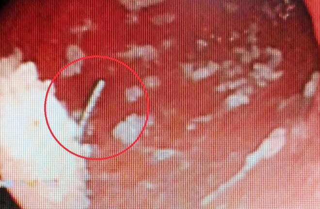 Gắp cây kim dài 2,5 cm trong bụng nam công nhân