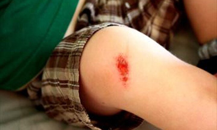 Hé lộ nguyên nhân bất ngờ khiến vết thương của bạn lâu lành